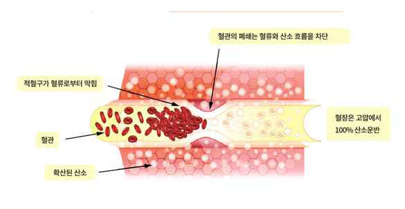 고압산소치료의 이차적 효과